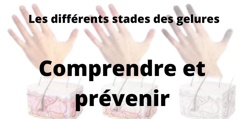 Gelure : causes et préventions